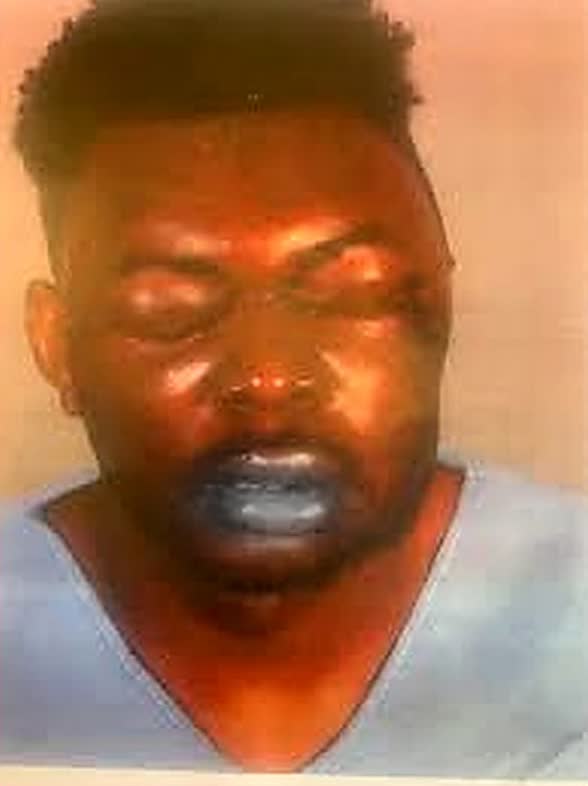 Christopher Bailey lost sight in one eye after Los Angeles deputies struck him 86 times — sparking a $4.75 million taxpayer payout